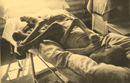 Ребенок-дистрофик